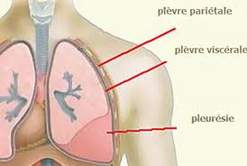 Chirurgie du cancer du poumon, opération pneumothorax - Cabinet Vannes